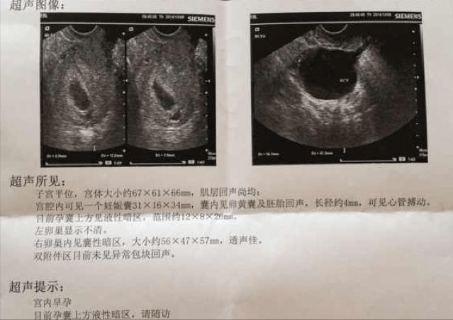 三个月孕囊图，揭示胚胎早期发育的神秘面纱